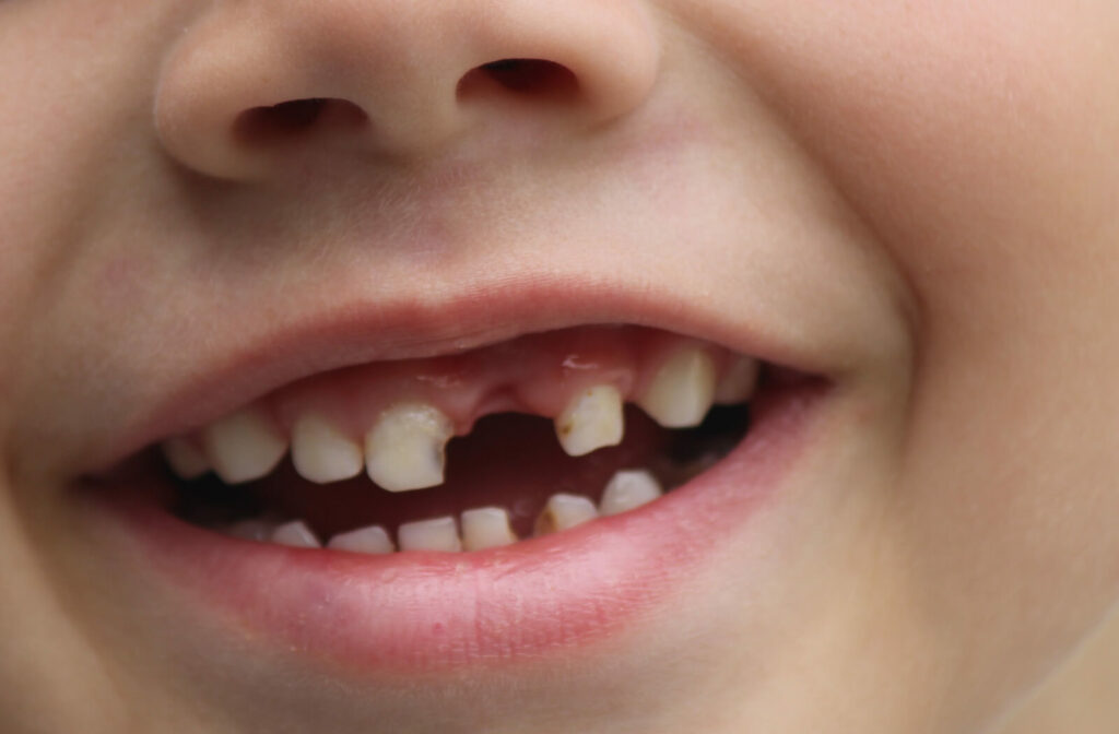 A close-up shot reveals a child's mouth, displaying dark cavities on their teeth.