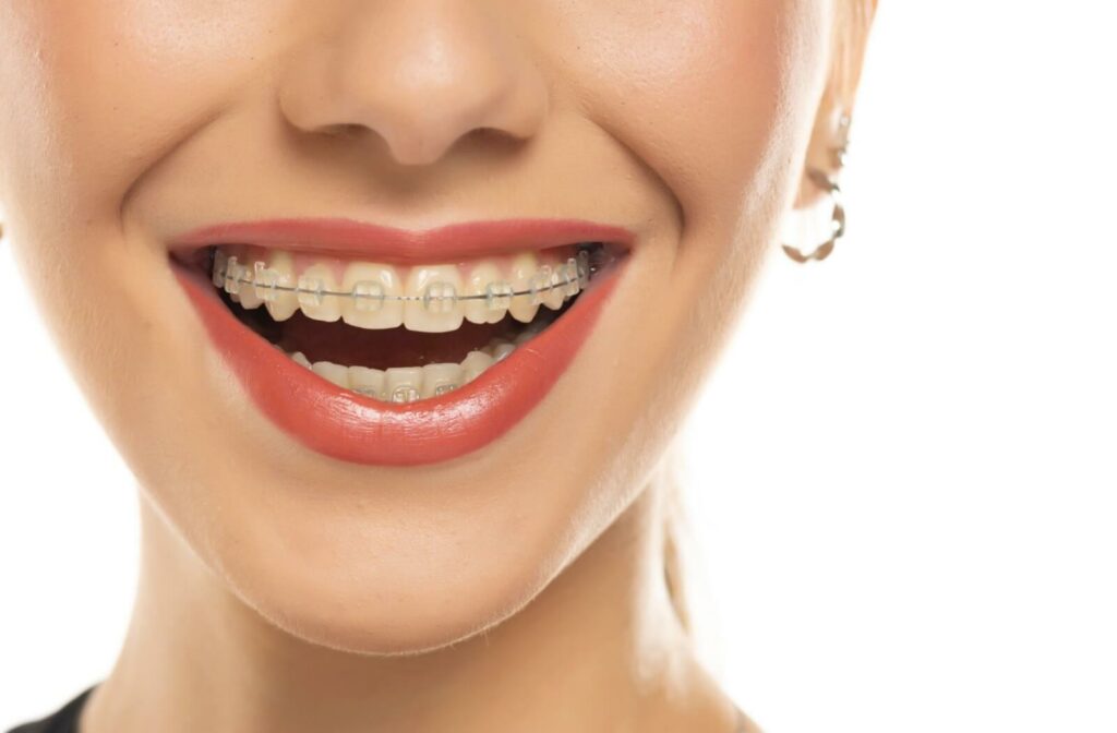 A woman wearing braces on her teeth.