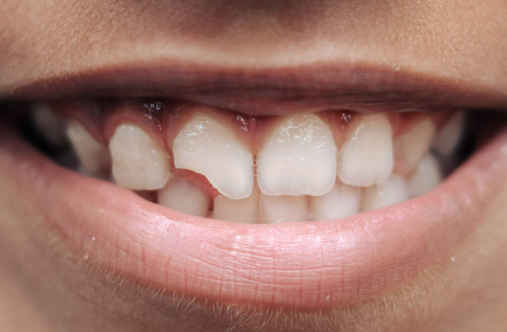 A close up view of a cracked front tooth needing a dental crown.